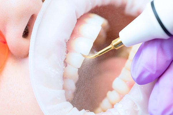 Чистка зубов ультразвуком в стоматологической клинике Дентал Визит