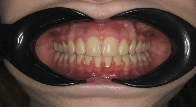 Фото после проведения услуги Самолигирующие брекеты