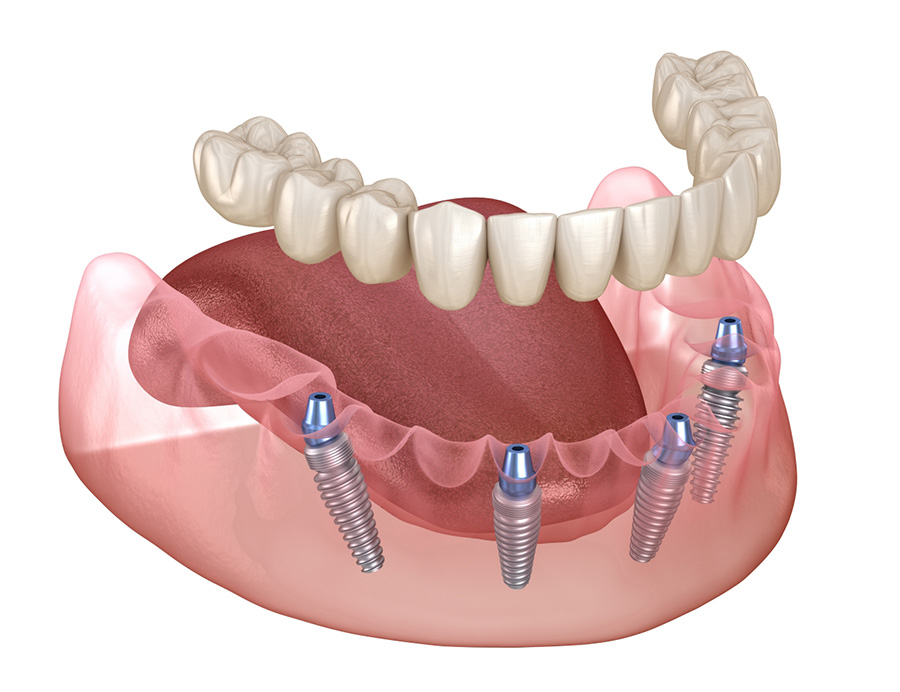 Имплантация All-on-4 в стоматологической клинике Дентал Визит