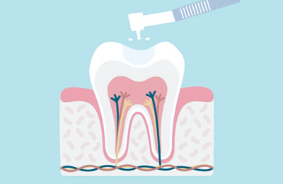 Подготовка зуба к пломбированию