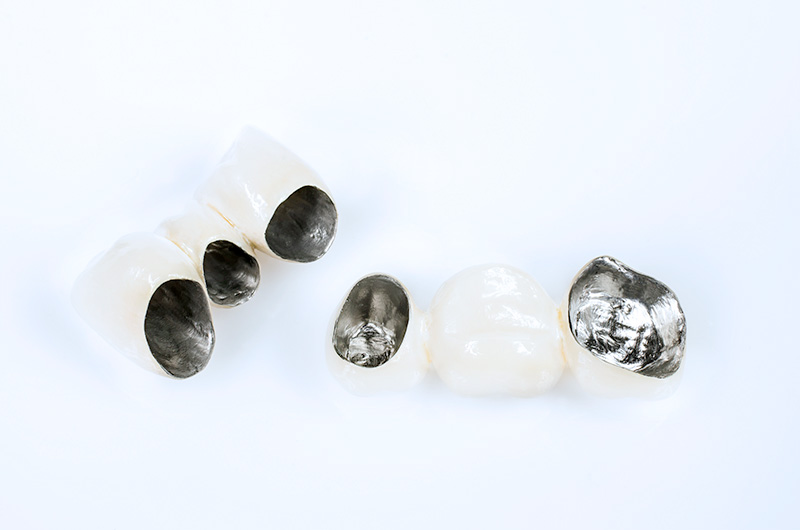 Металлокерамические коронки в стоматологической клинике Дентал Визит