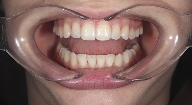 Фото после проведения услуги Каппы элайнеры