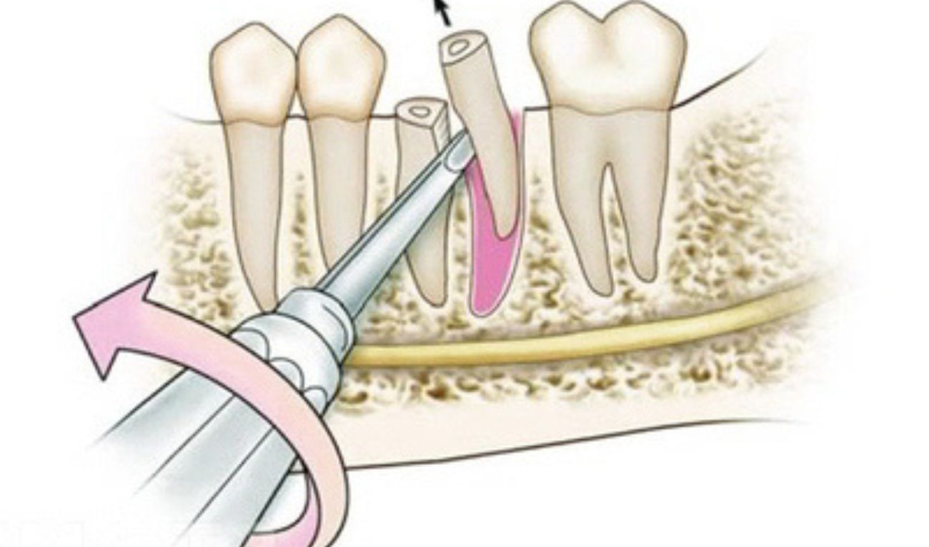 Сложное удаление корня зуба: когда требуется операция
