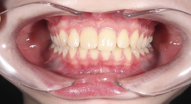 Фото до проведения услуги Самолигирующие брекеты