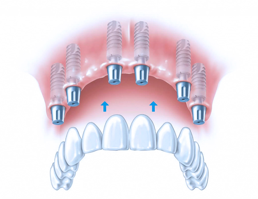 Имплантация All-on-6 в стоматологической клинике Дентал Визит