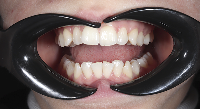 Фото до проведения услуги Каппы элайнеры