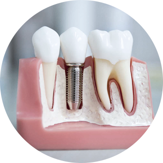 Статьи по имплантации зубов