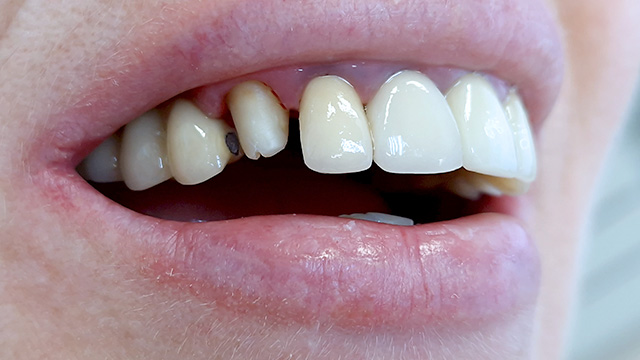 Обточка зуба