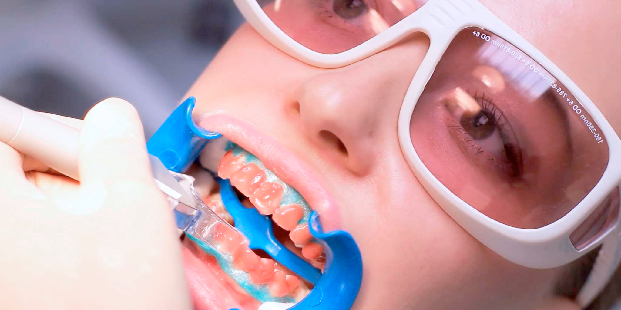 Лазерное отбеливание в стоматологической клинике Дентал Визит