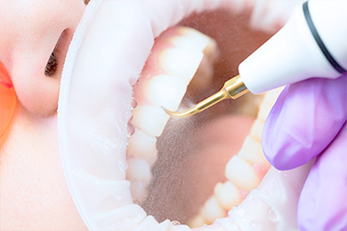 Подготовка зубов