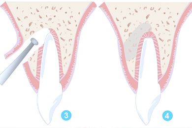 Операция резекции верхушки корни зуба
