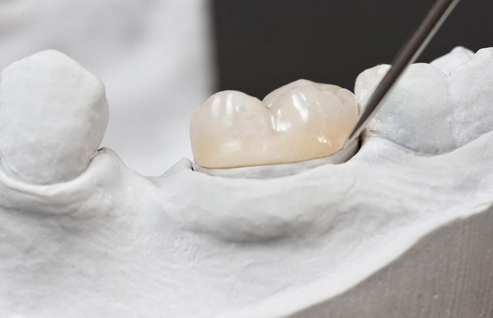 tipos-coronas-dentales-barcelona-dental-care.jpeg