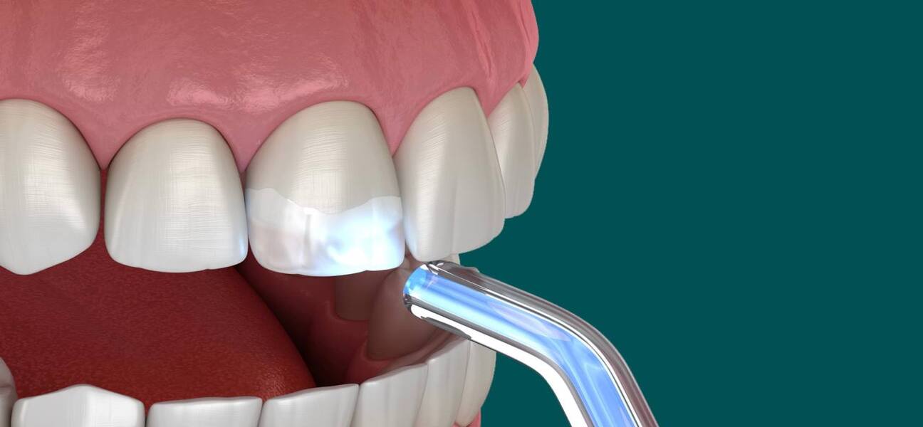 Художественная реставрация передних зубов: что нужно знать